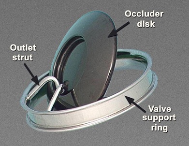 Fatigue, heart valve Fatigue, heart valve